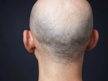 hair-bald-2025-01-b306d7fbbafba202a36c8b7021c53e15 hair-bald-2025-01-b306d7fbbafba202a36c8b7021c53e15